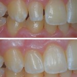 Conservative Direct Resin Veener on Young Patient