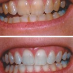 Cosmetic Tooth Whitening