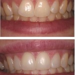 Crowded and mishapen teeth corrected using Direct Composite Resin Veneers.