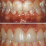 Excess tissue covering teeth and discolorations to Conserative Direct Resin Veneers