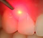 laser treatment