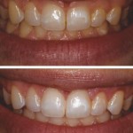 Excess Tissue removed using the Laser and Whitening