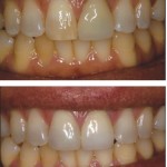 Oversized/Unesthetic crown (left central)Discolored Incisor (right central) to All Ceramic Crown (left central) Direct Resin Veneer (right central)