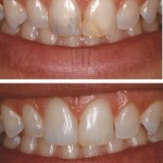 Pins present and restorations visible to Invisible Direct Resin Restorations