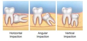 remove wisdom teeth