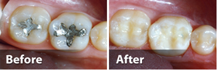 Dental Fillings Portland OR - Tooth-colored Composite Fillings