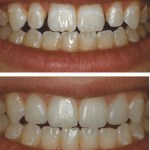 Tooth Whitening, Tissue and Enamel Reshaping, Conservative Direct Resin Veneers