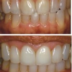 Unesthetic Crowns & Translucent Laterals treated with Direct Resin Veneers & All Ceramic Crowns