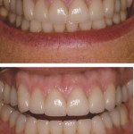 Full Mouth rehabilitation with All-Ceramic Crowns and Ceramic Veneers