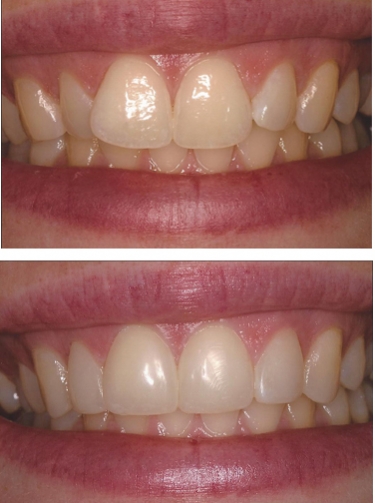 Middle - Excess Tissue removed using the Laser and Whitening. 