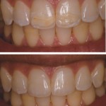 Restored discoloration with Direct Resin